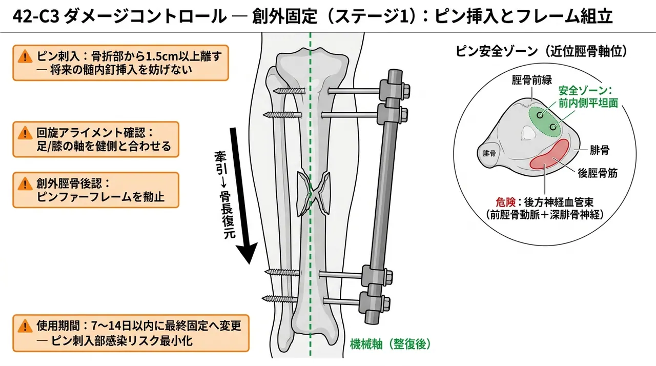 創外固定（ダメージコントロール） — 近位・遠位Schanzピン配置・フレーム構成・アライメント確認