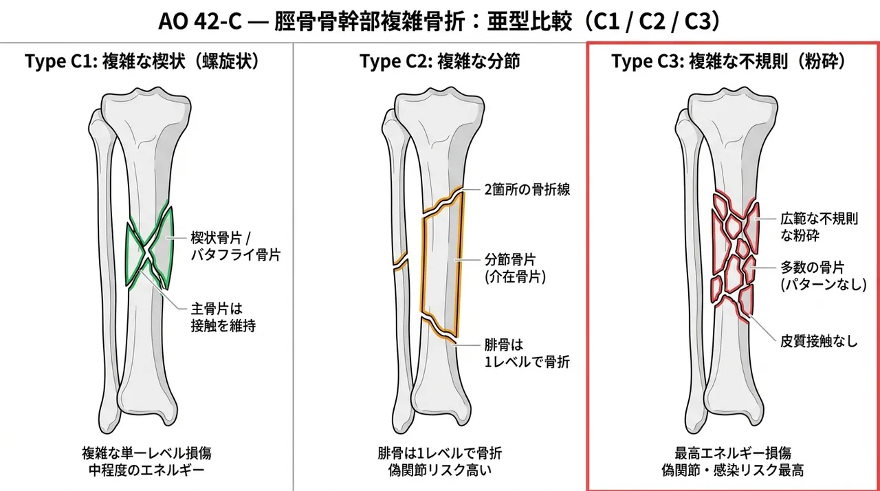 骨折パターン分類 — 42-C1（複雑螺旋）vs 42-C2（分節型）vs 42-C3（不規則粉砕型）比較