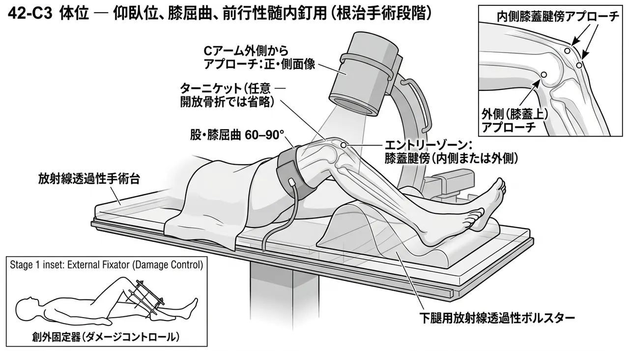 手術体位 — 仰臥位・膝屈曲30°〜60°・ターニケット（閉鎖骨折）・C-arm設置位置