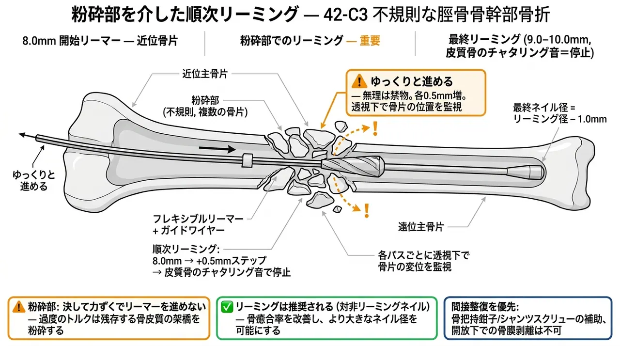 リーミング（段階的拡髄）— 不規則粉砕型では骨片転位を最小化しながら慎重にリーミング