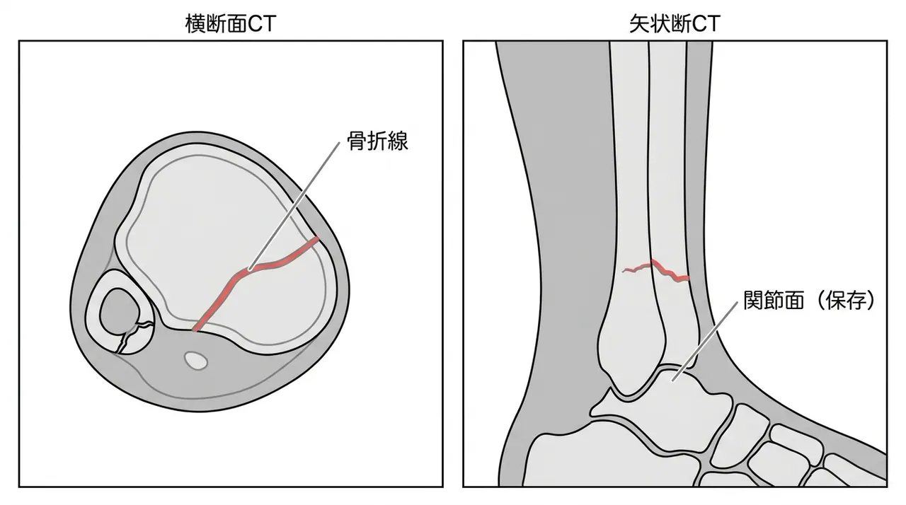 CT横断面・矢状断面 — 関節面の連続性確認・粉砕評価・腓骨骨折評価
