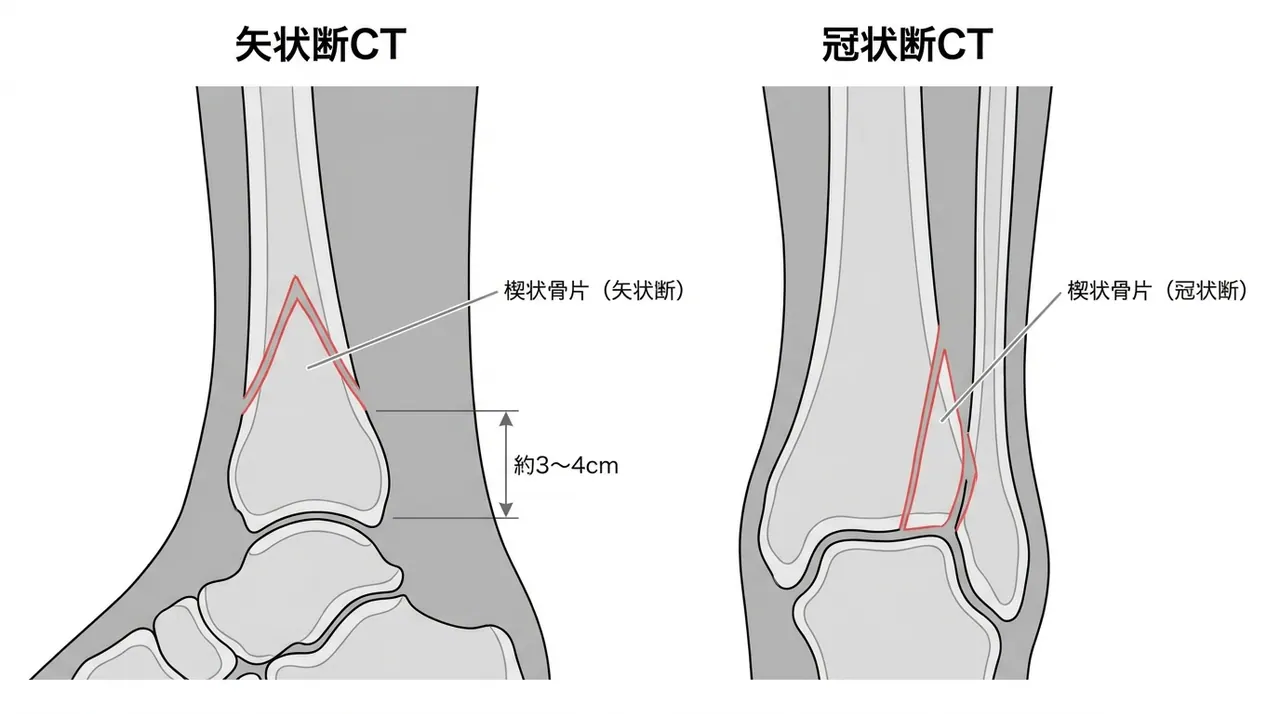 CT矢状断・冠状断 — 楔状骨片の形態・関節面からの距離・転位量を三次元的に評価