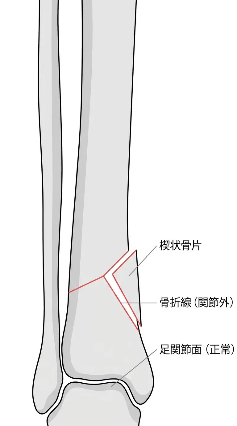 術前X線正面像 — 脛骨遠位骨幹端に楔状骨折線（関節面に達しない）、内側皮質の連続性確認