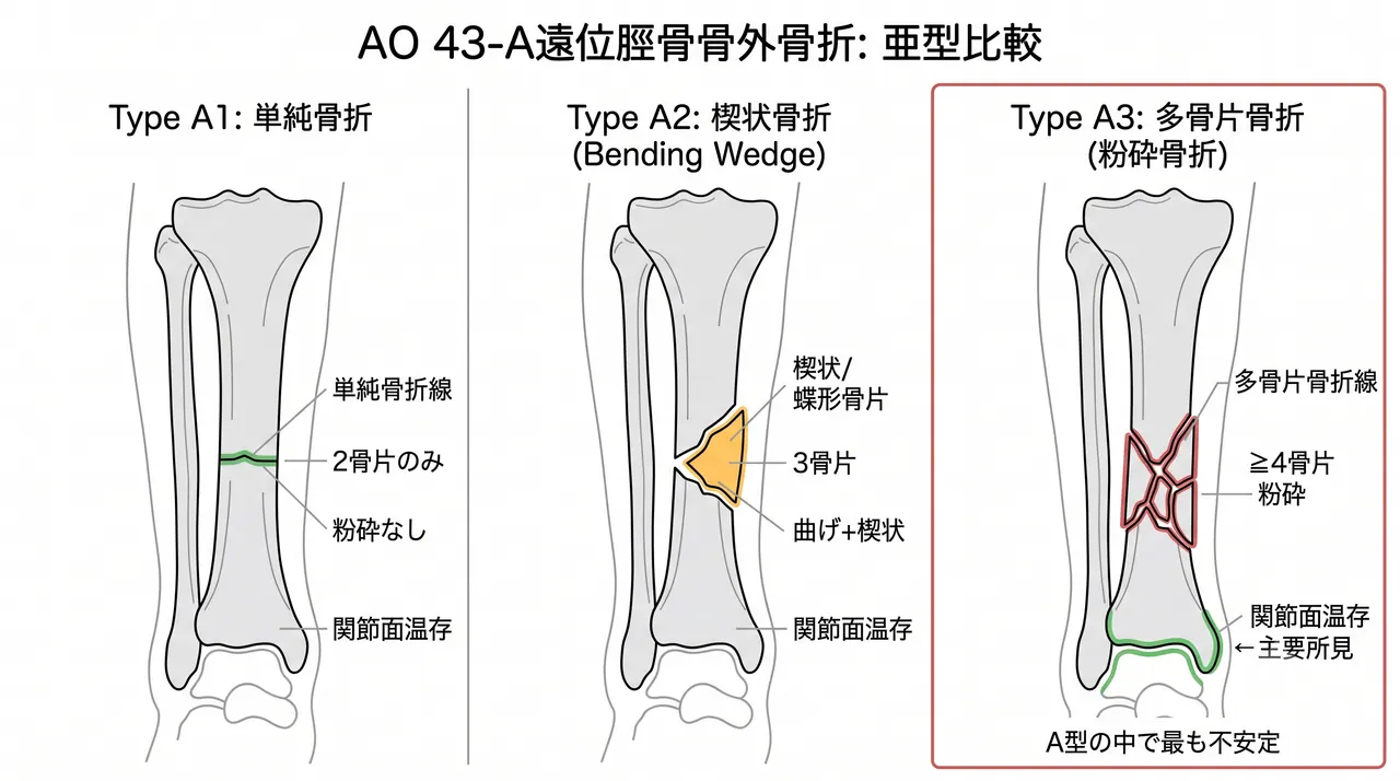 AO 43-A分類比較 — 43-A1（単純）vs 43-A2（楔状）vs 43-A3（粉砕型）の骨折線パターン