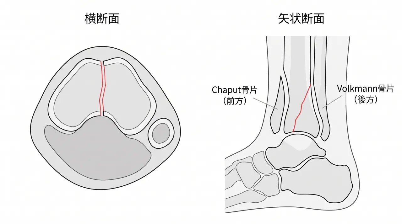 CT横断面・矢状断面 — 骨折線の方向・関節面転位量・骨片形態の評価