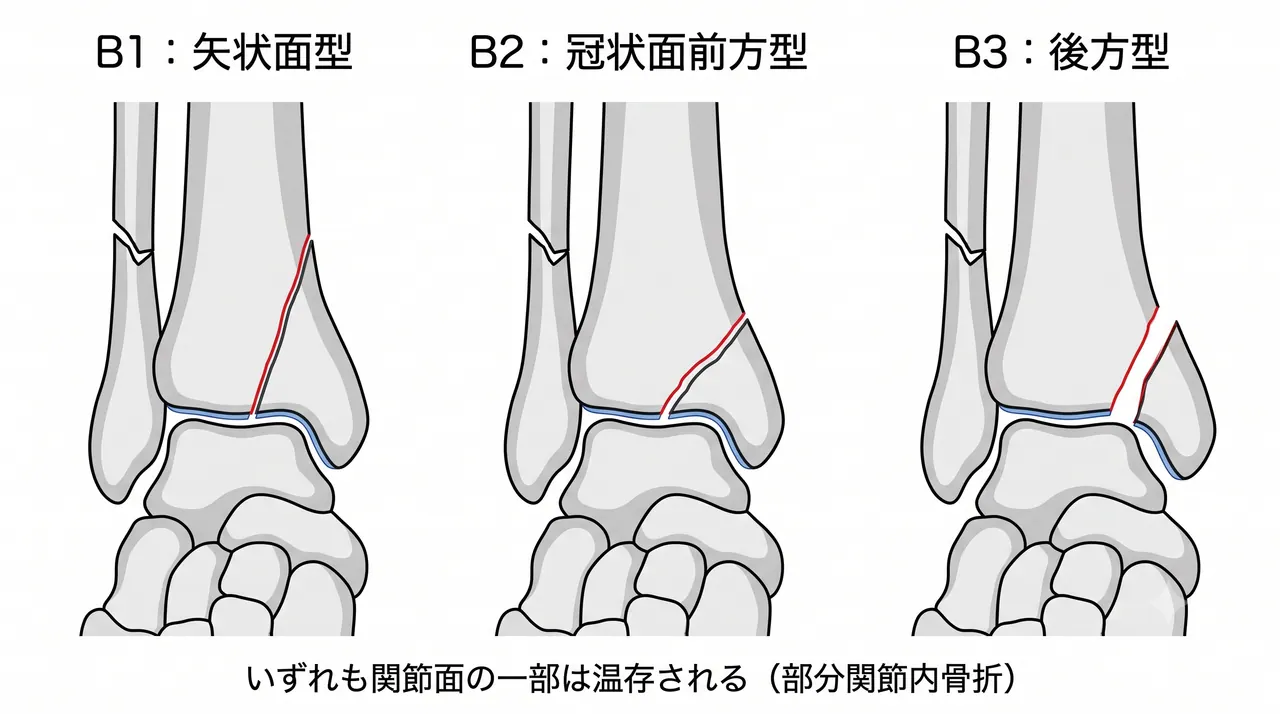43-B骨折分類比較 — B1（矢状面型）vs B2（冠状面前方型）vs B3（後方型）の3パネル模式図