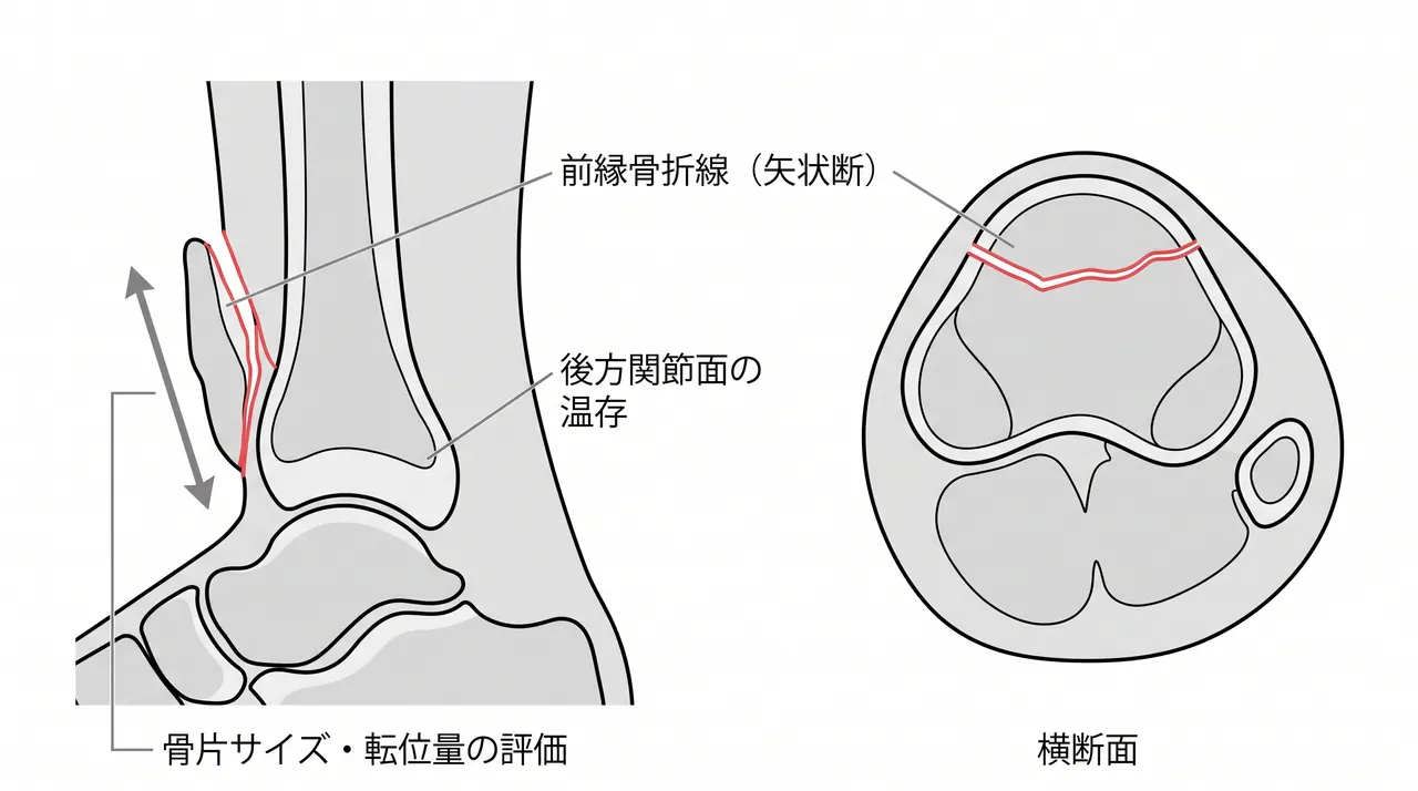 CT矢状断面・横断面 — 前縁骨折線の走行・骨片サイズ・後方関節面の温存程度の評価