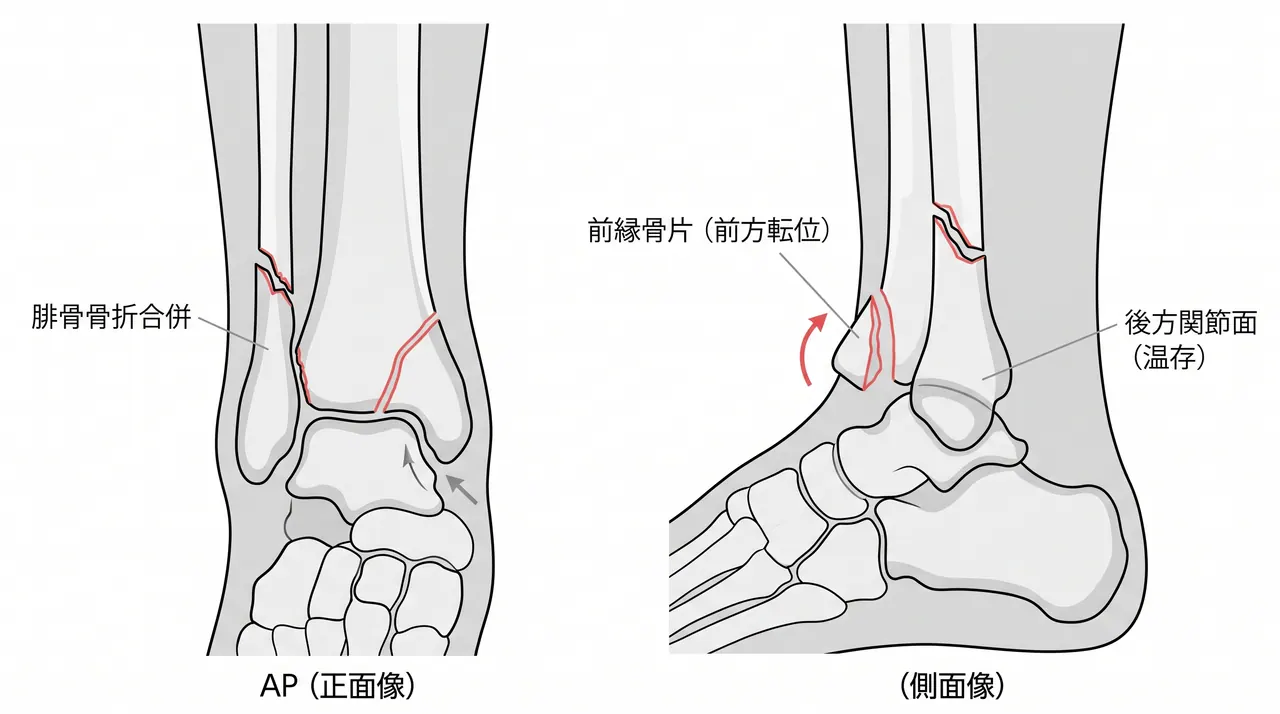 術前X線正面像・側面像 — 前縁骨片の転位（側面像で前方骨片の剥離が明瞭）・腓骨骨折の評価