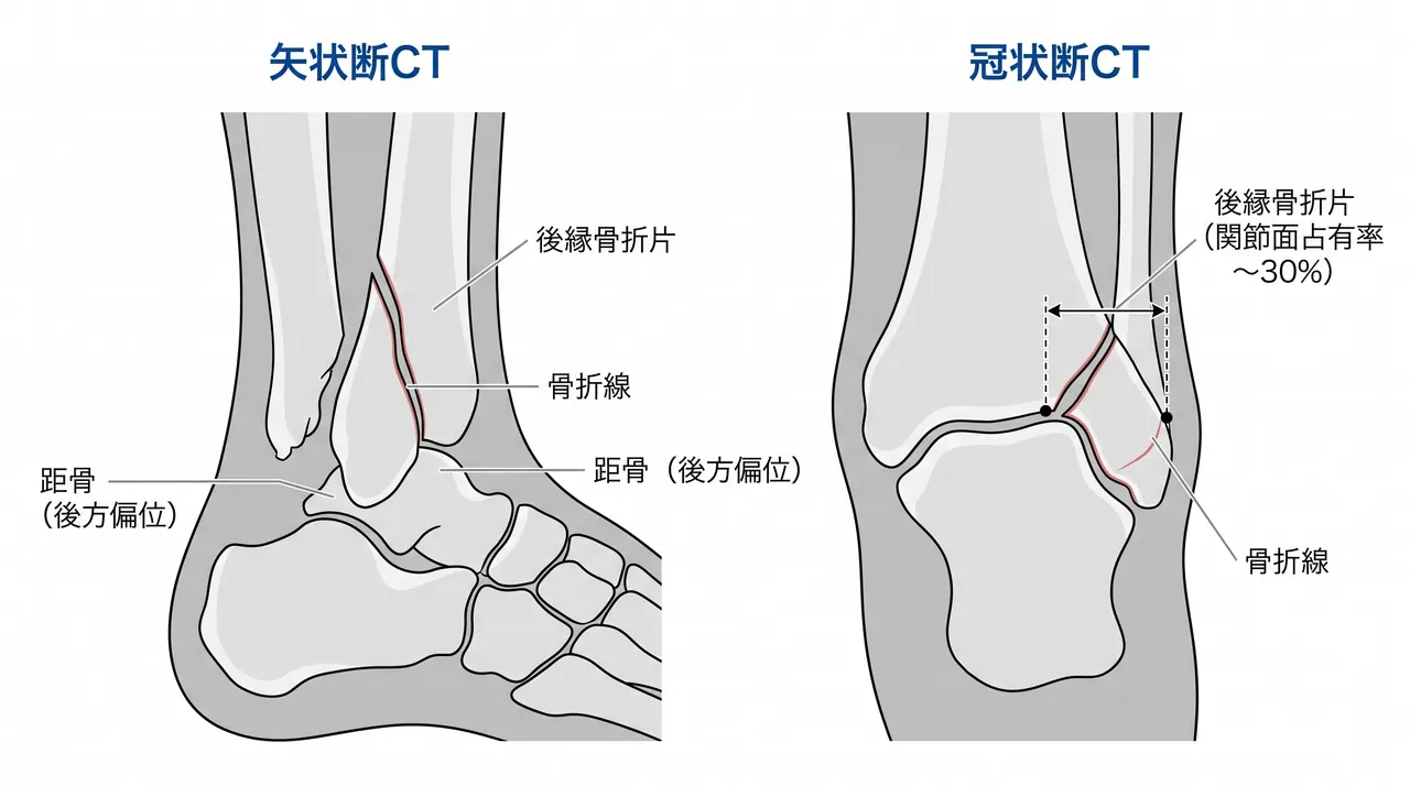 CT矢状断・冠状断 — 後縁骨折片の大きさ（関節面占有率）・転位量・骨折線パターンを三次元評価