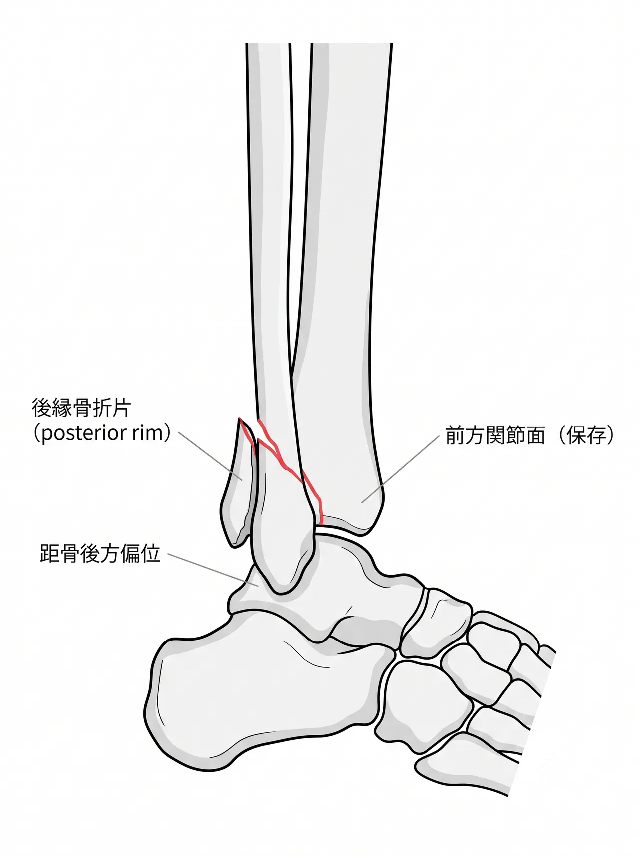 術前X線側面像 — 後縁骨片（posterior rim fragment）と距骨の後方偏位。骨折片のサイズ・転位量を確認
