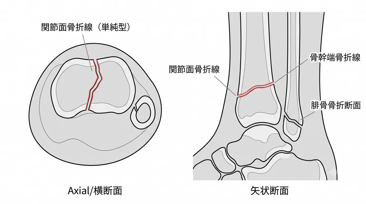 CT横断面・矢状断面 — 関節面骨折線の方向・骨片数・転位量の三次元評価。術前プレート選択の根拠となる