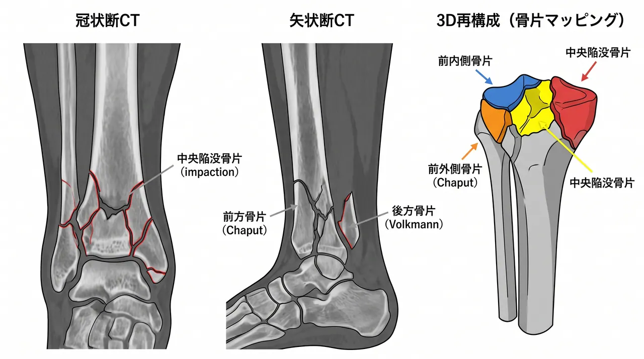 CT冠状断・矢状断・3D再構成 — Volkmann骨片・Chaput骨片・中央陥没骨片のマッピング