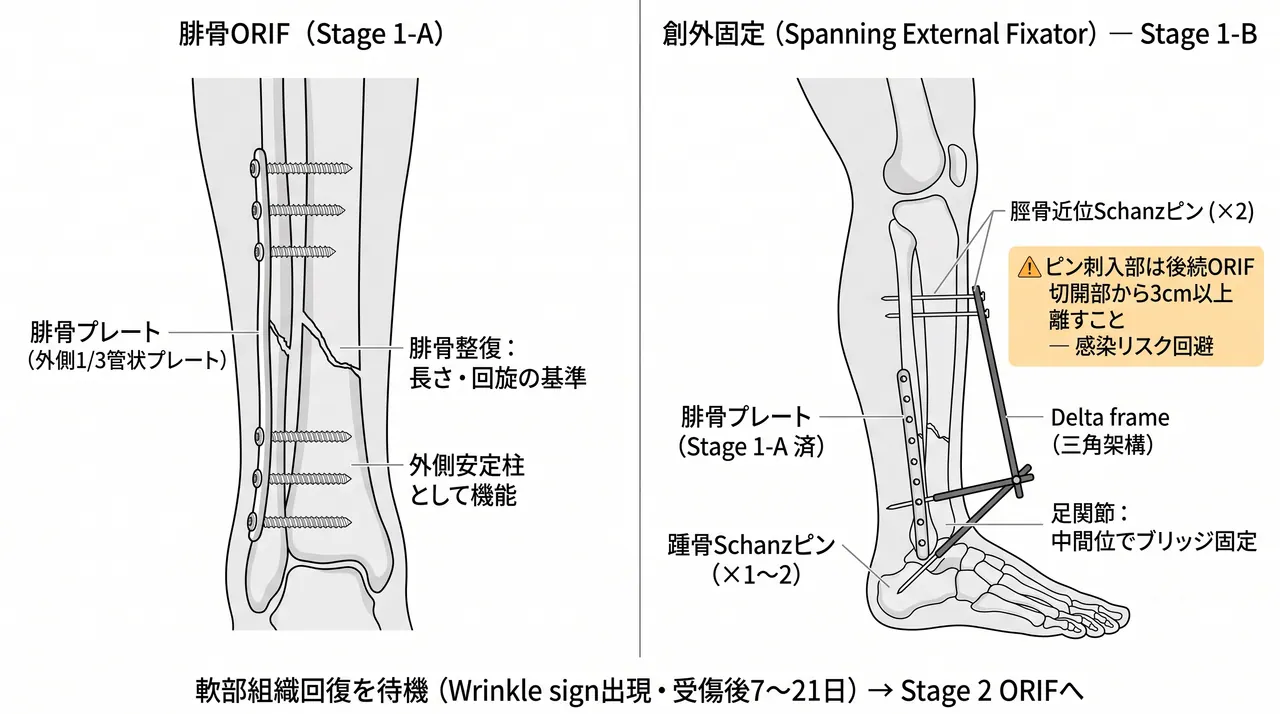 Stage 1：腓骨プレート固定＋大腿〜足部架橋創外固定器。Delta frame構成とSchanz pinの刺入位置