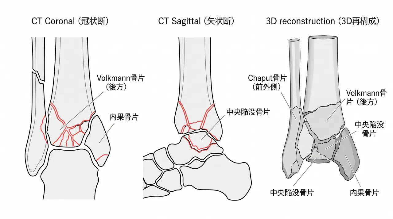 CT冠状断・矢状断・3D再構成 — Volkmann骨片・Chaput骨片・中央陥没骨片・前方骨片のマッピング。骨欠損範囲の評価