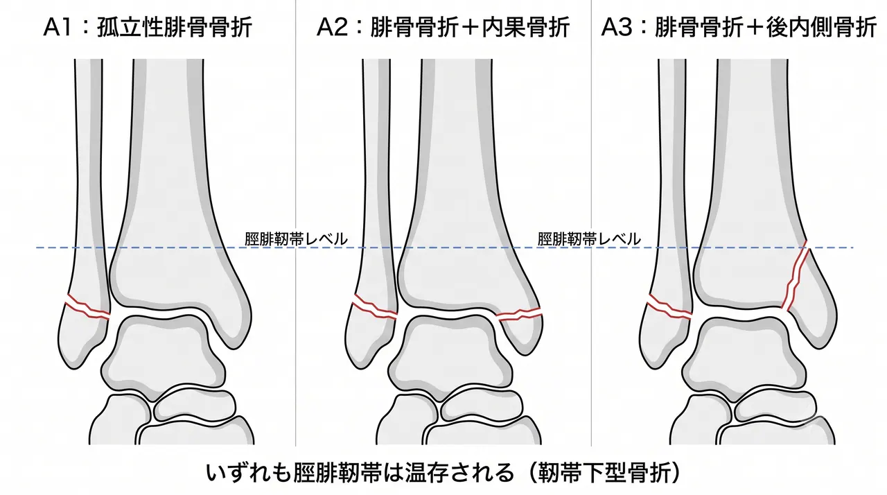 44-A骨折分類比較 — A1（孤立性腓骨遠位端骨折）vs A2（腓骨骨折＋内果骨折）vs A3（腓骨骨折＋後内側骨折）の3パネル模式図