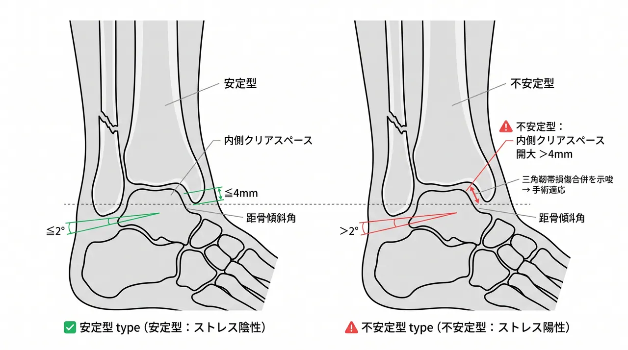 外反ストレスX線像（重力ストレス像）— 距骨傾斜角の評価（≦2°が安定型）と内側クリアスペースの変化