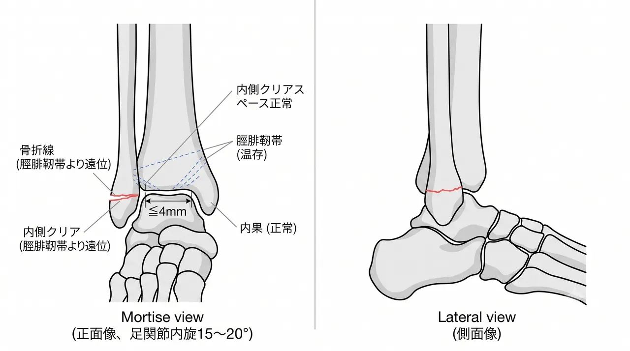 術前X線正面像（mortise view）・側面像 — 腓骨遠位端横骨折（脛腓靭帯より遠位）・足関節モルティス正常・内側クリアスペース評価