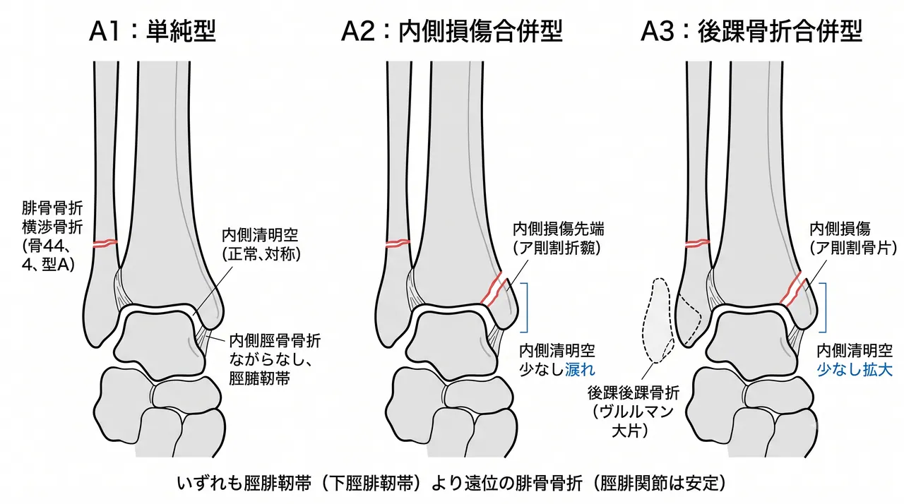 44-A骨折分類比較 — A1（脛腓靭帯下型・単純）vs A2（脛腓靭帯下型・内側損傷合併）vs A3（脛腓靭帯下型・内側損傷合併・後踝骨折あり）の3パネル模式図