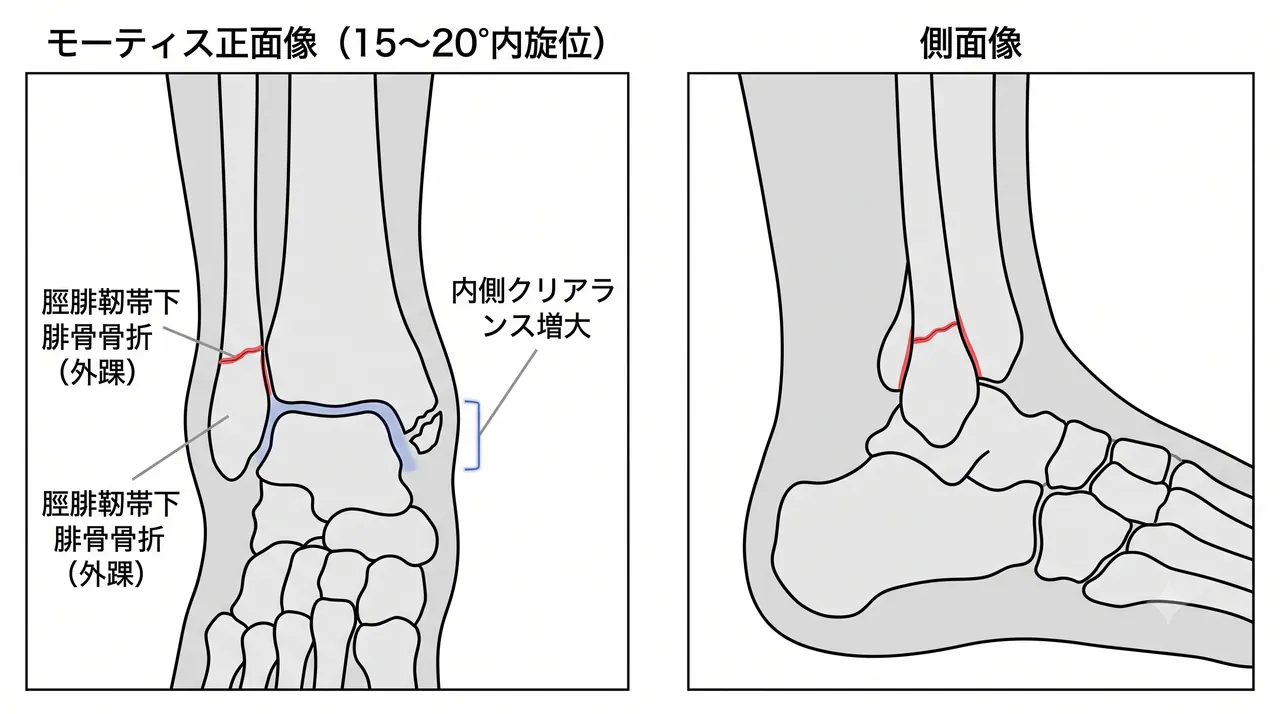 術前X線（mortise view・側面像）— 脛腓靭帯下腓骨骨折・内側クリアランス増大・距骨傾斜の所見