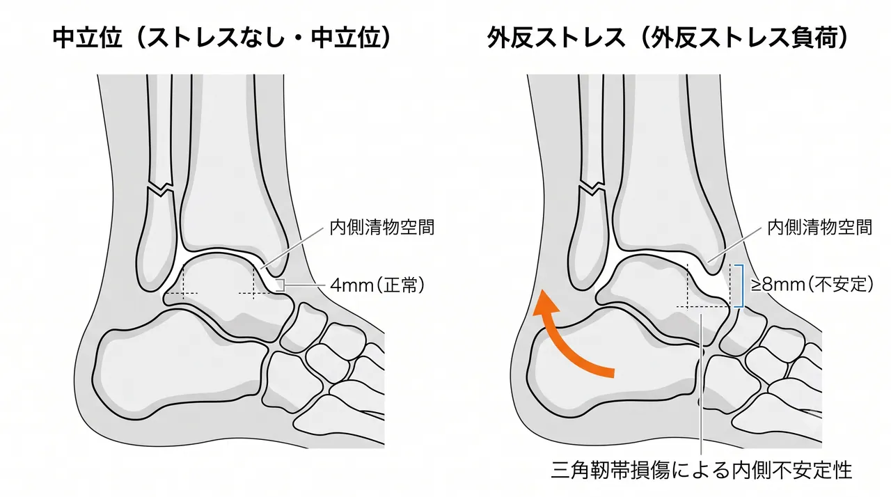 ストレスX線（外反ストレス）— 内側クリアランス増大・距骨傾斜による内側不安定性の評価