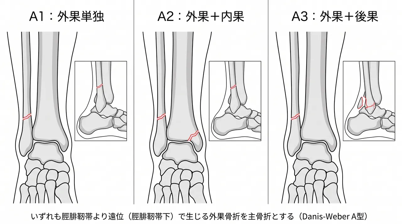44-A骨折分類比較 — A1（外果単独）vs A2（外果＋内果）vs A3（外果＋後果）の3パネル模式図