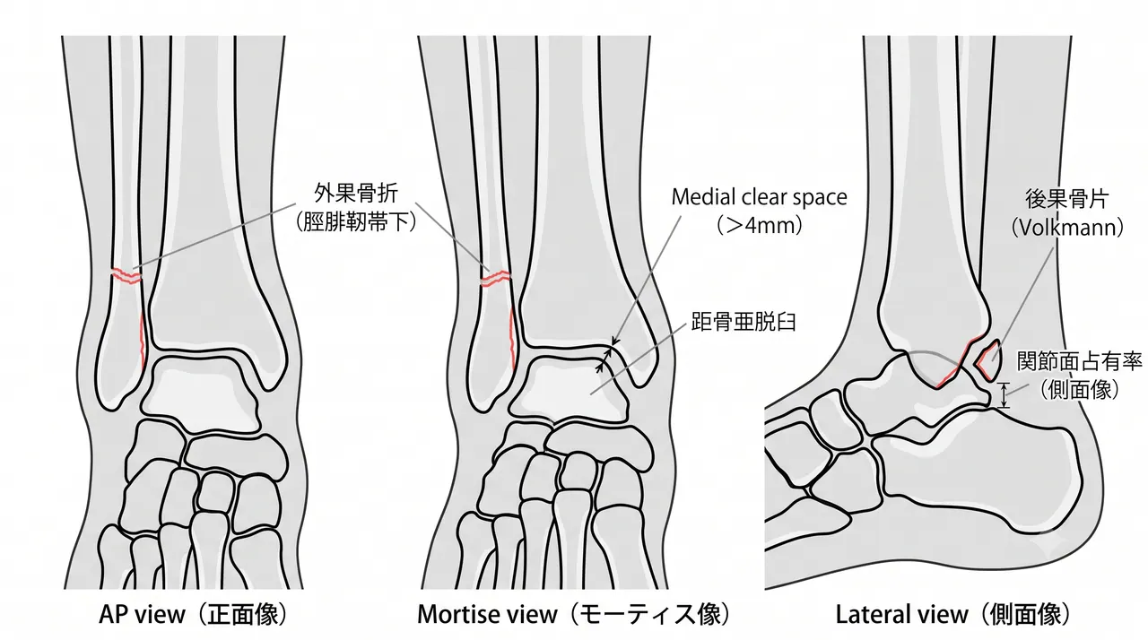 術前X線正面像・側面像・モーティス像 — 外果骨折（脛腓靭帯下）と後果骨片（Volkmann骨片）の評価