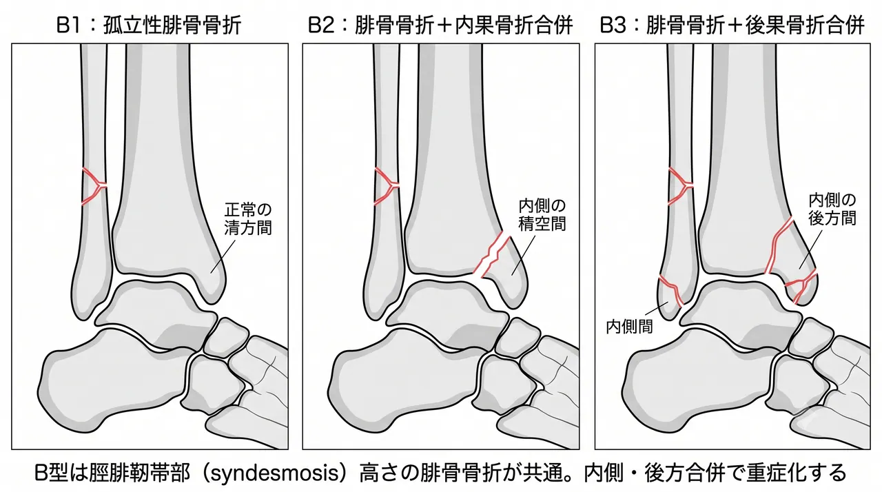 44-B骨折分類比較 — B1（孤立性腓骨骨折）vs B2（内果合併）vs B3（内果骨折＋後果合併）の3パネル模式図