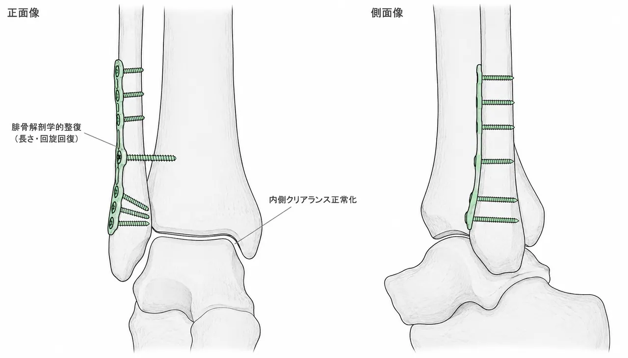術後X線正面像（Mortise view）・側面像 — 腓骨解剖学的プレート固定。腓骨長・回旋・内側クリアランス回復を確認