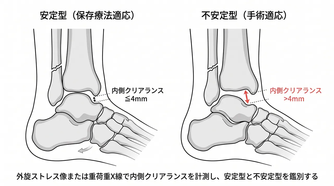 ストレスX線評価 — 外旋ストレス像での内側クリアランス計測（正常 vs 不安定型の比較）