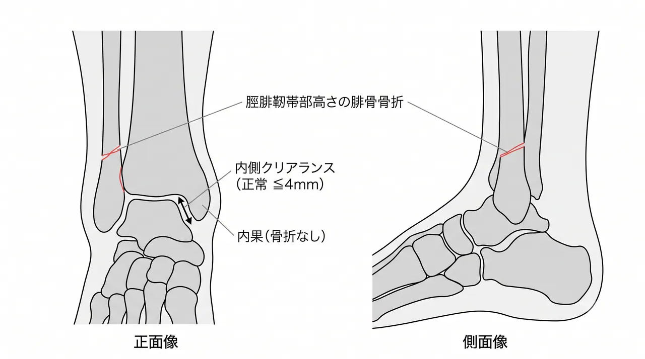 術前X線正面像（Mortise view）・側面像 — 脛腓靭帯部高さの腓骨骨折と内側クリアランス評価