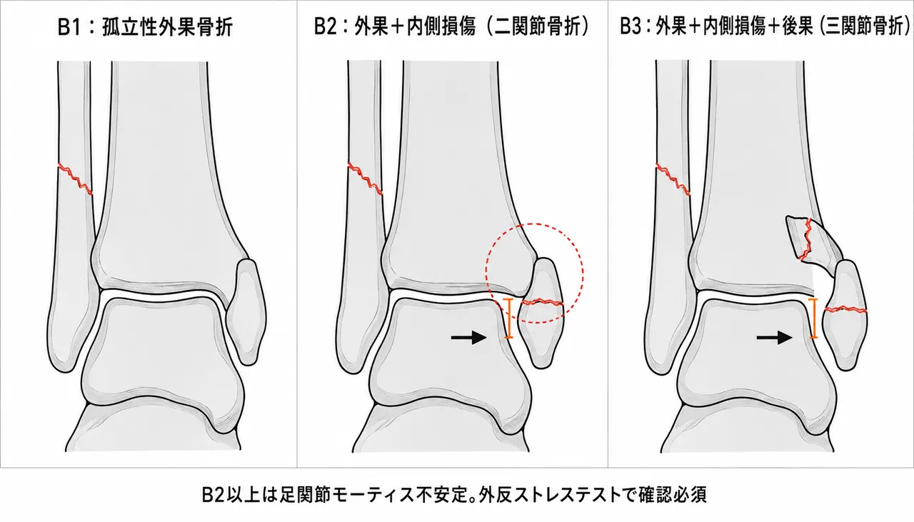 44-B骨折分類比較 — B1（孤立性外果）vs B2（外果＋内側損傷）vs B3（外果＋内側損傷＋後果）の3パネル模式図