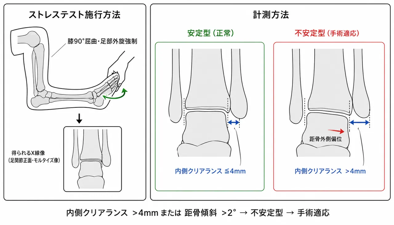 外反ストレステスト — 内側クリアランス計測・距骨傾斜角の評価方法の模式図