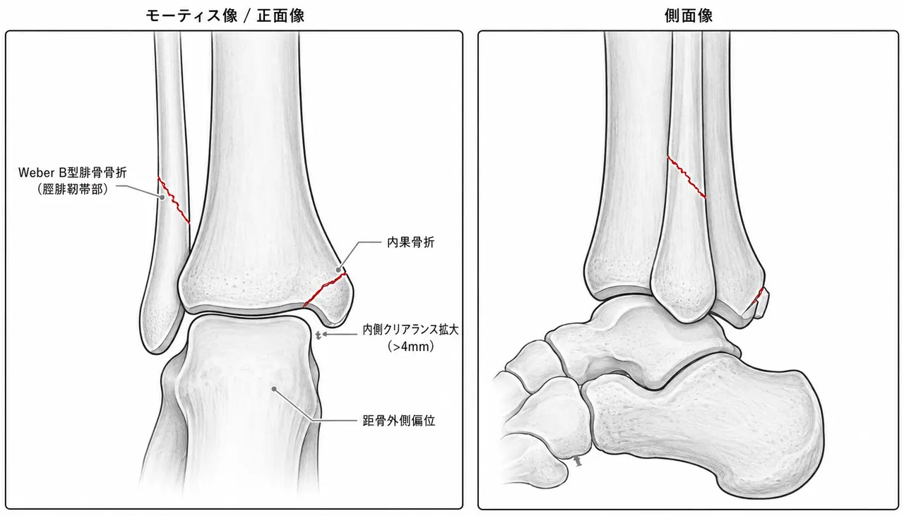 術前X線正面像（Mortise View）・側面像 — Weber B型腓骨骨折・内果骨折・モーティス幅拡大の確認