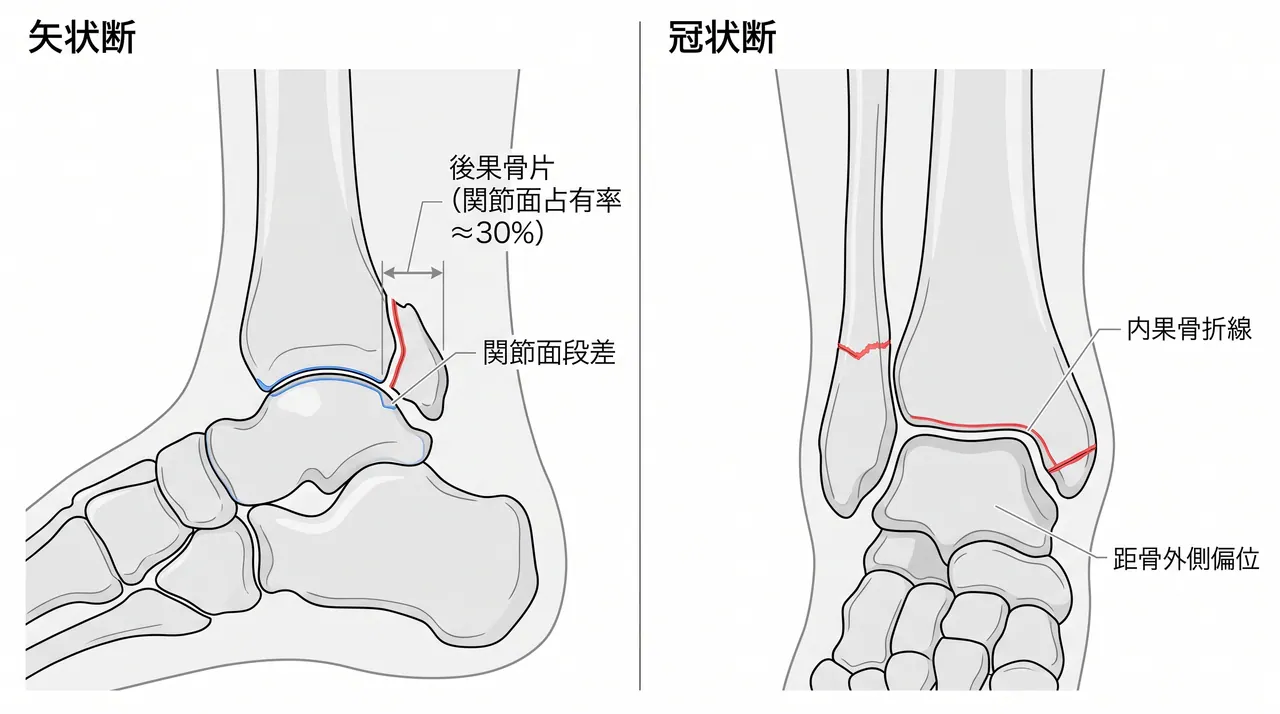 CT矢状断・冠状断 — 後果骨片の関節面占有率・転位量・内果骨折線方向の評価