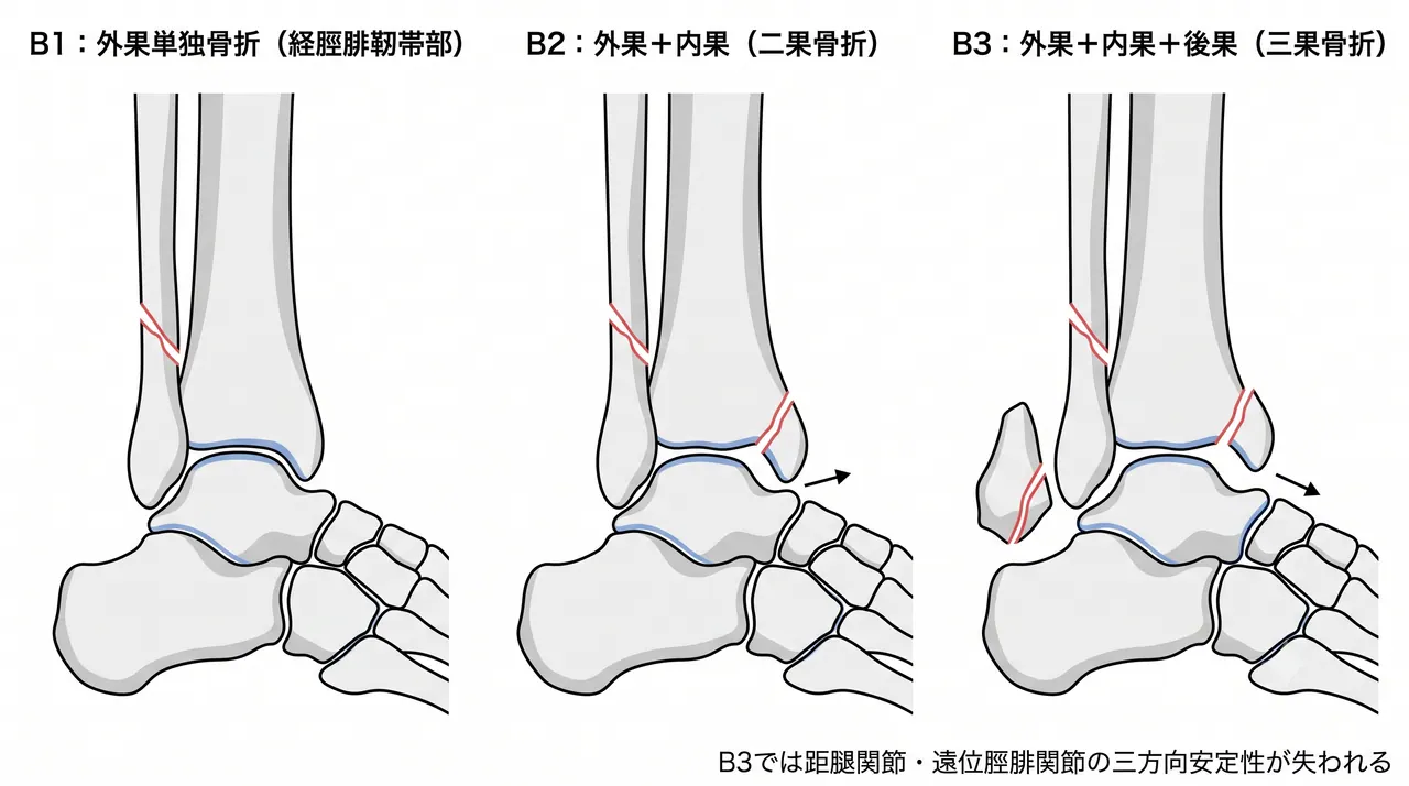44-B骨折分類比較 — B1（外果単独）vs B2（外果＋内果）vs B3（外果＋内果＋後果：三果）の3パネル模式図