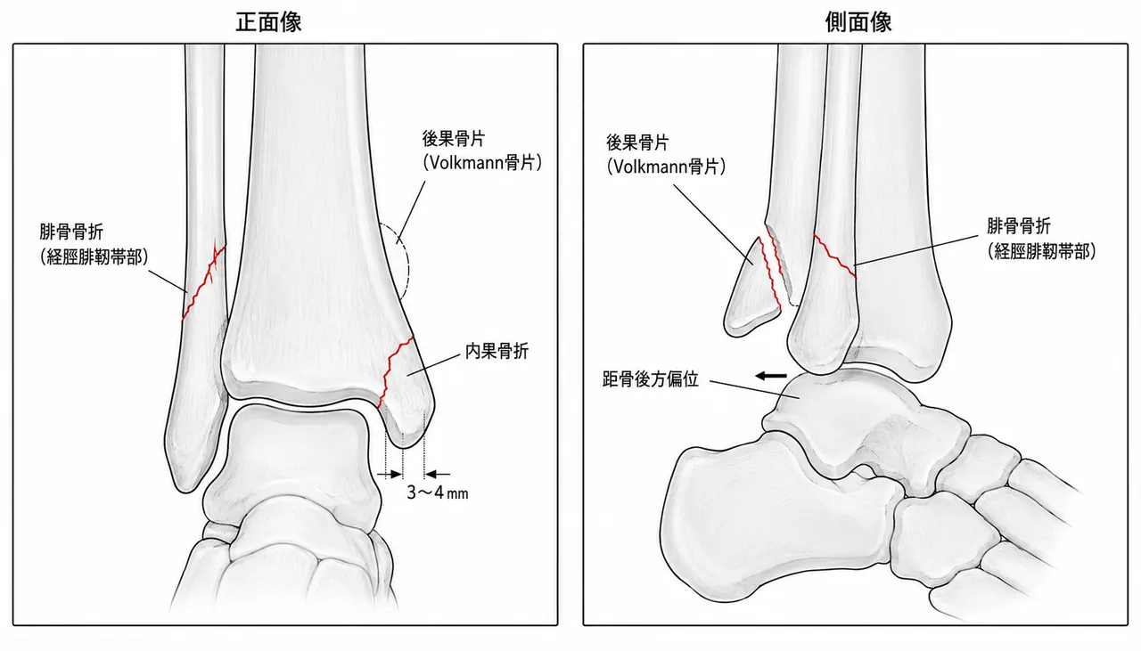 術前X線正面像（mortise view）・側面像 — 経脛腓靭帯部腓骨骨折・内果骨折・後果骨折（Volkmann骨片）の確認