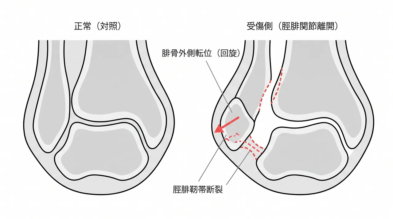 CT横断面 — 遠位脛腓関節離開・腓骨回旋転位・後果骨折合併の有無評価