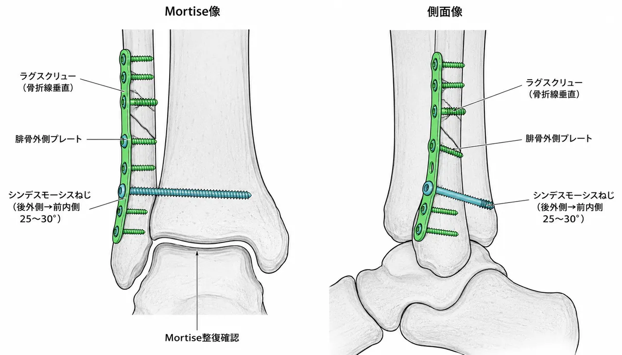 腓骨ORIF術中透視像（Mortise view・側面）— 腓骨外側プレート・ラグスクリューによる単純腓骨骨折の整復固定