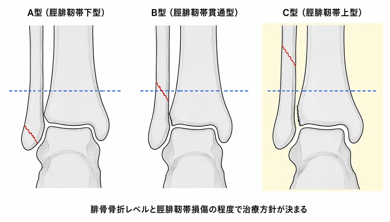44-C1骨折分類模式図 — 脛腓靭帯上型（C型）vs 脛腓靭帯貫通型（B型）vs 脛腓靭帯下型（A型）の腓骨骨折レベル比較