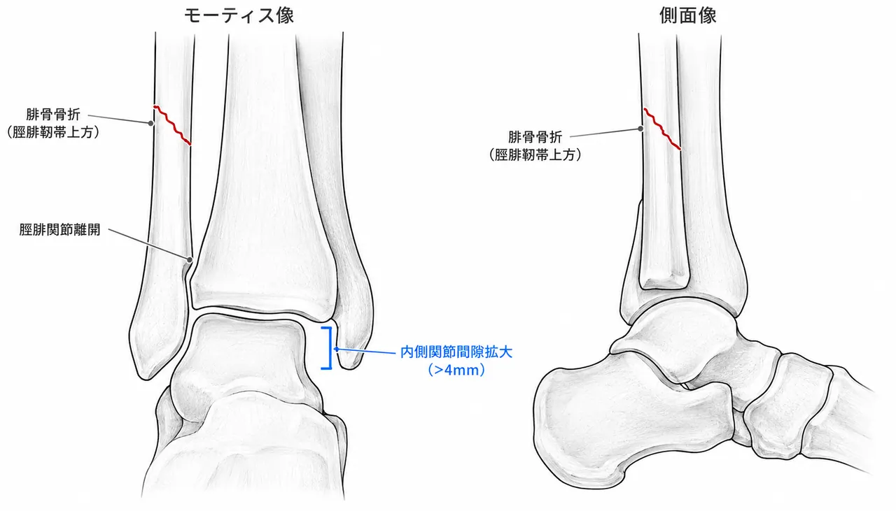 術前X線（Mortise view・側面像）— 脛腓靭帯上型腓骨骨折・Medial clear space拡大・脛腓関節離開