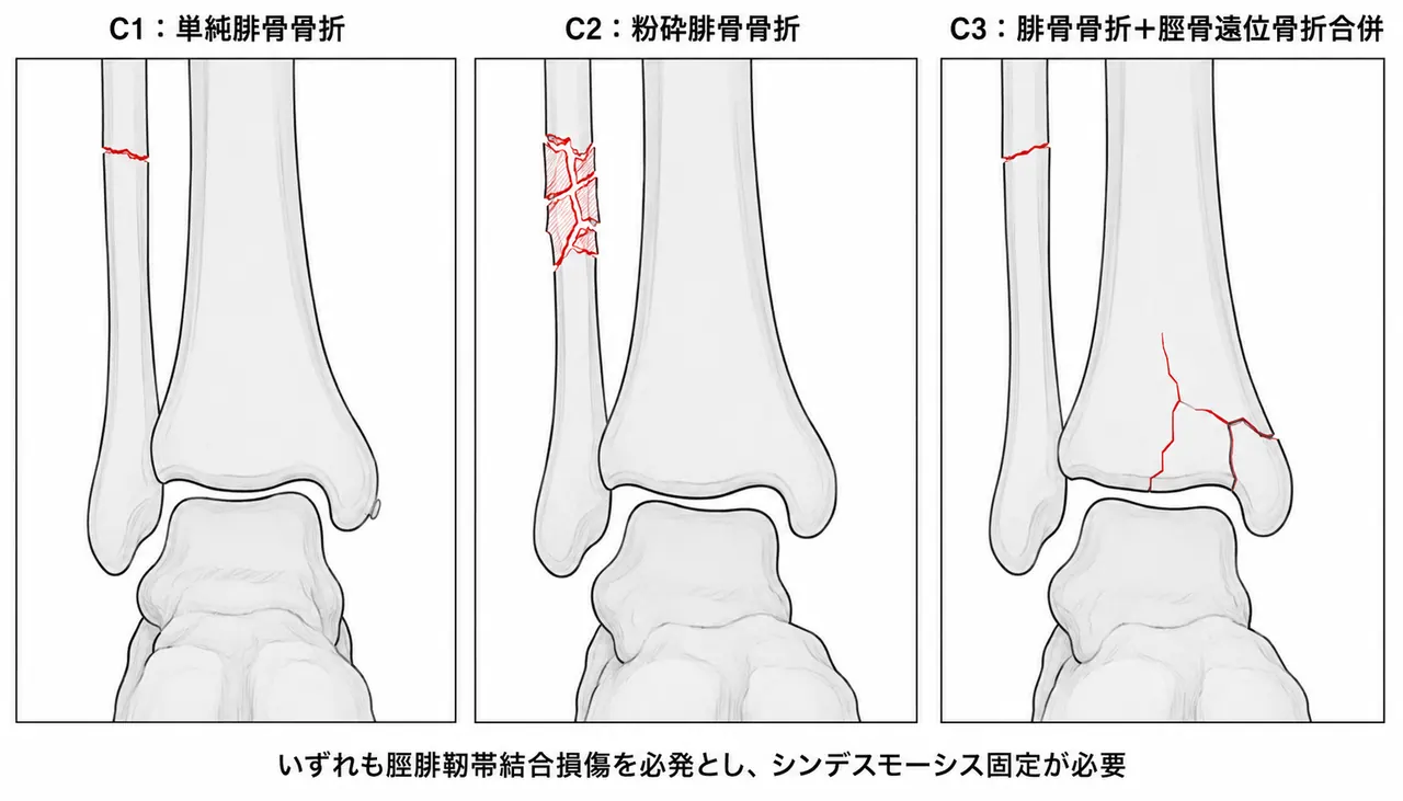 44-C骨折分類比較 — C1（単純腓骨骨折）vs C2（粉砕腓骨骨折）vs C3（腓骨骨折＋脛骨遠位骨折）の3パネル模式図
