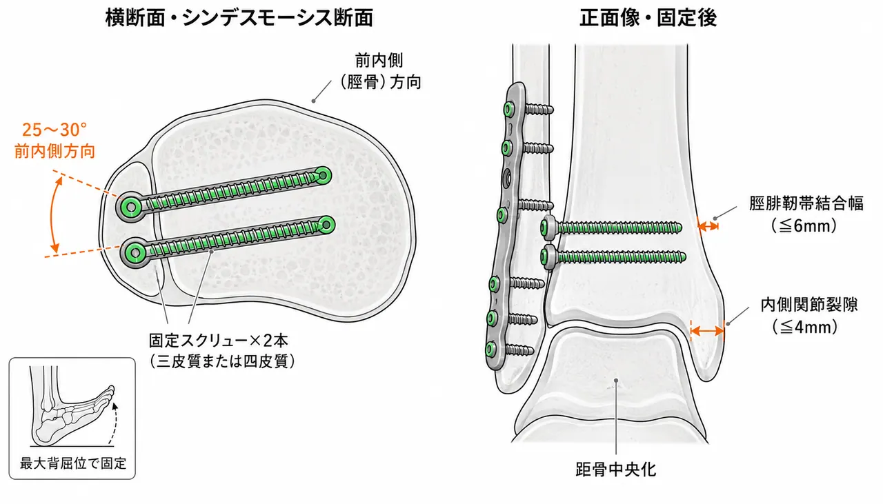 シンデスモーシス固定の手技 — 足関節中立〜背屈位保持・スクリュー刺入方向（腓骨後外側→脛骨前内側）・モーティスビューでの確認