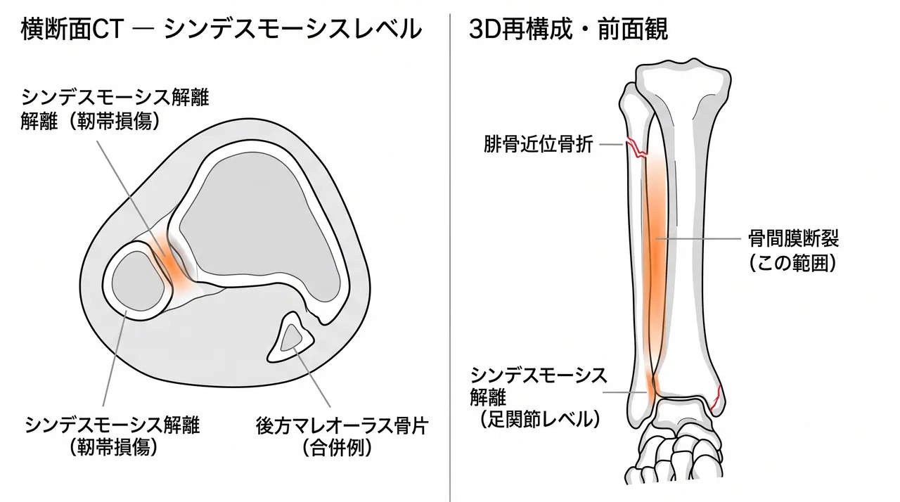 CT横断面・3D再構成 — シンデスモーシス解離・後方マレオーラス骨折・内果骨折の評価