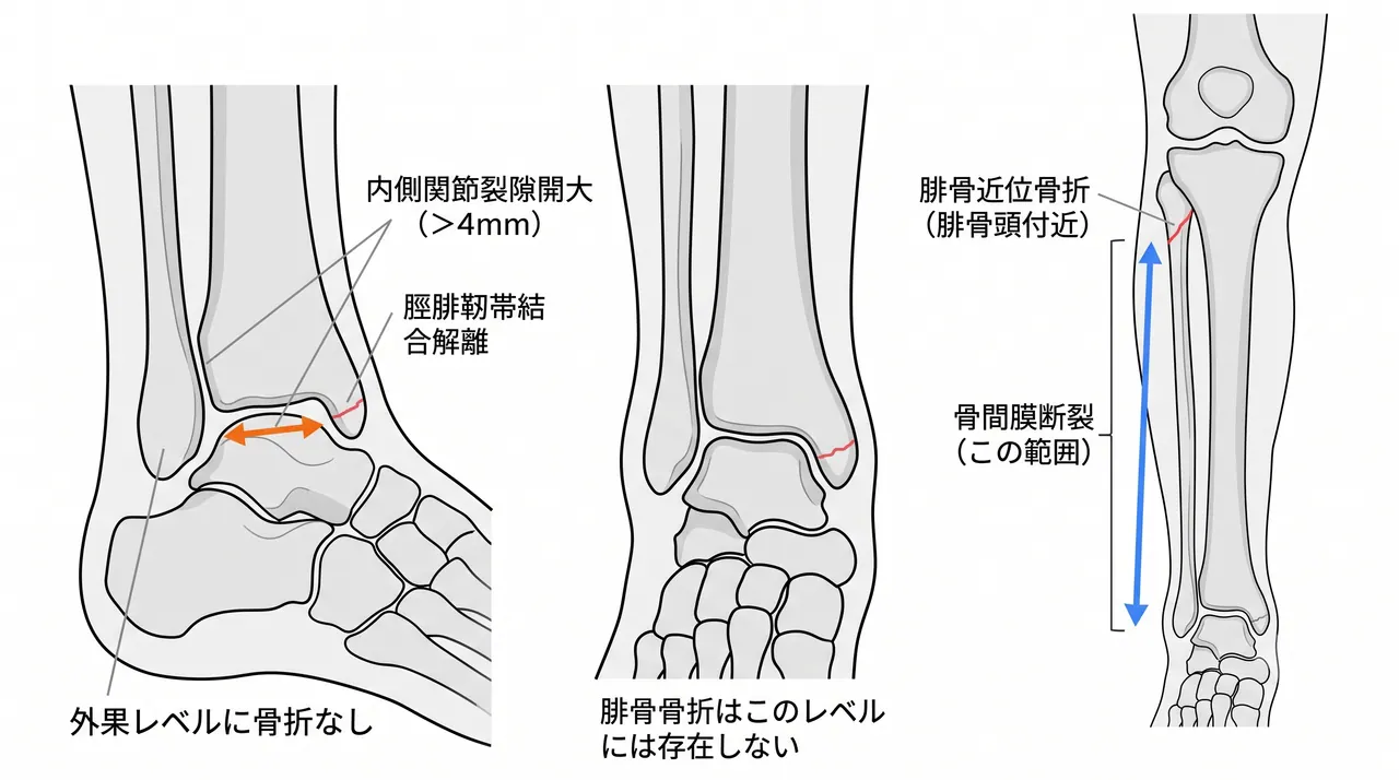 術前X線モーティスビュー・正面像・下腿全長像 — 足関節モーティス開大（内側裂隙・脛腓靭帯結合解離）と腓骨近位部骨折の全体像