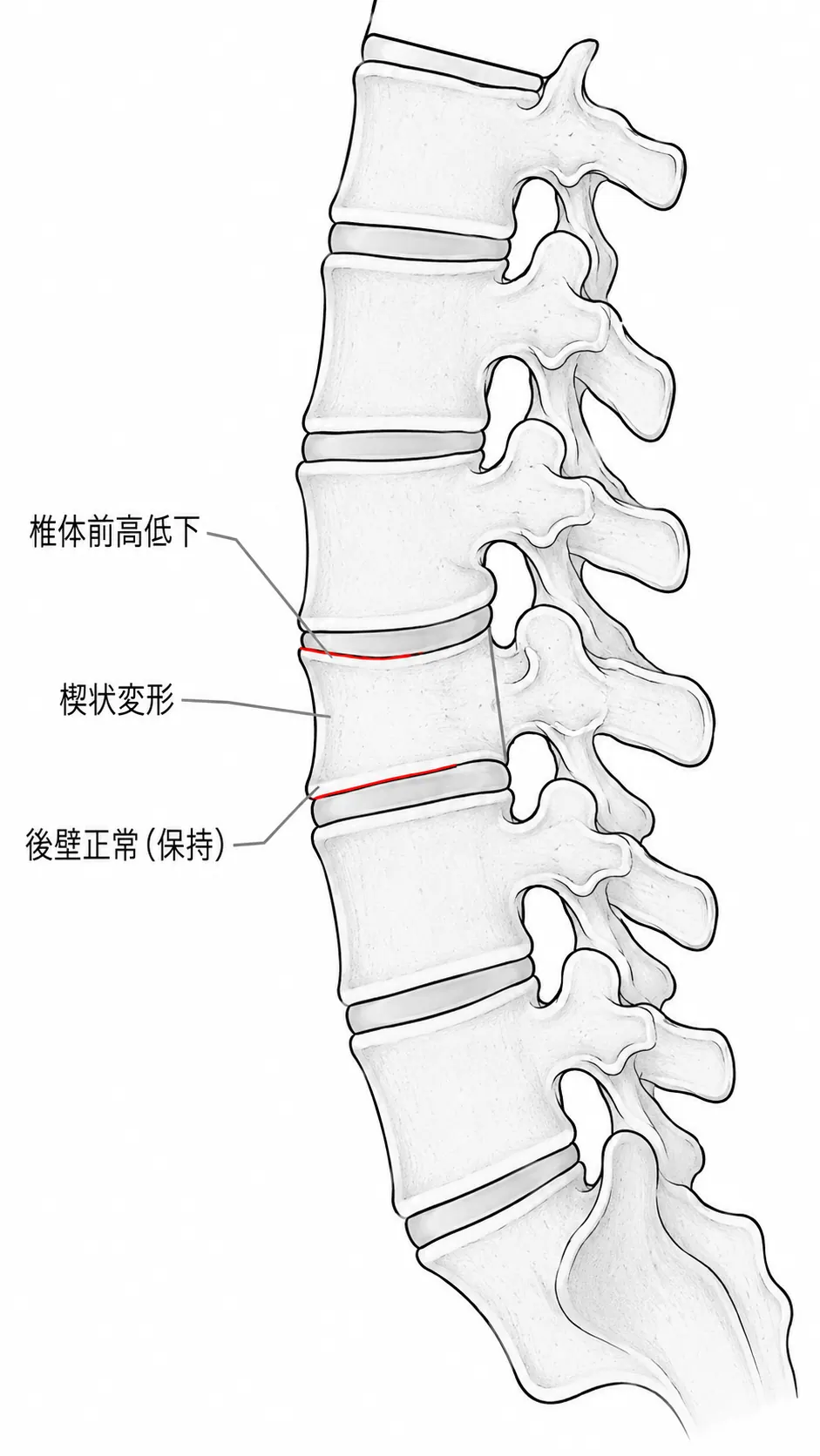 X線側面像 — 椎体前高低下・楔状圧迫変形（Th12/L1典型例）
