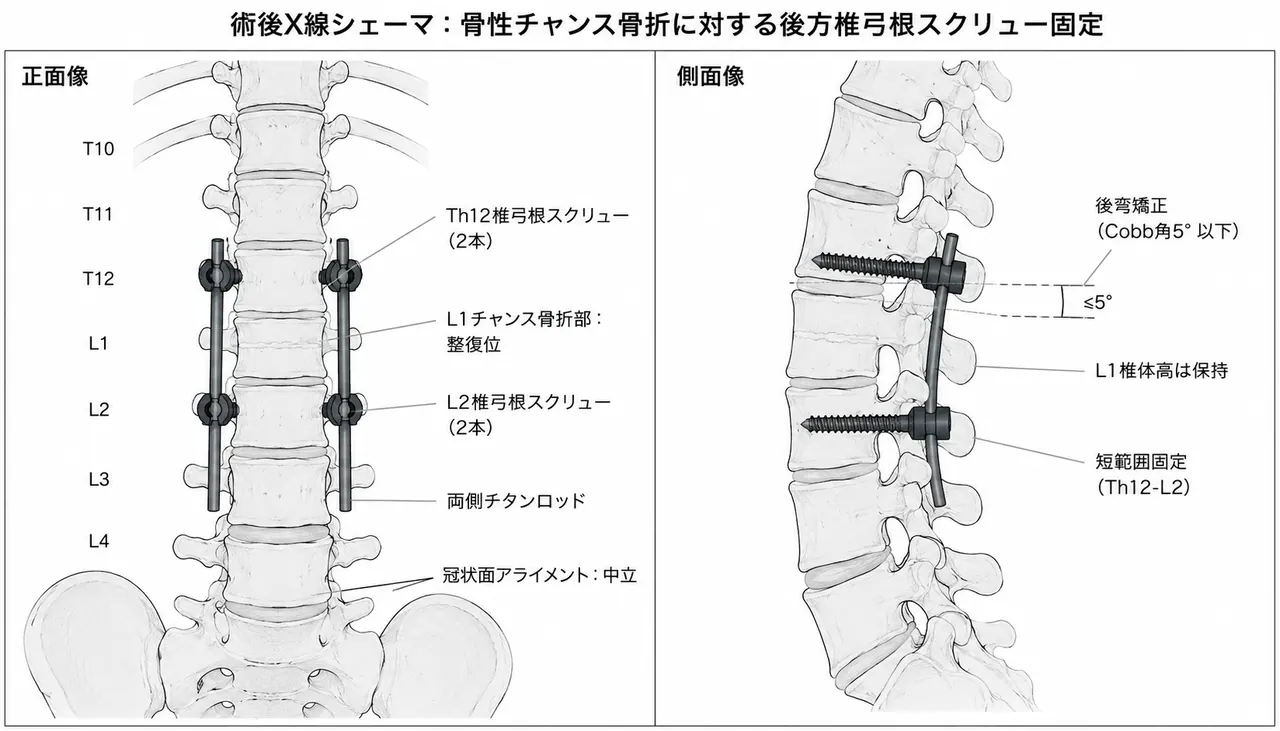 術後X線像（正面/側面）— ペディクルスクリュー固定後のChance骨折整復・後弯矯正