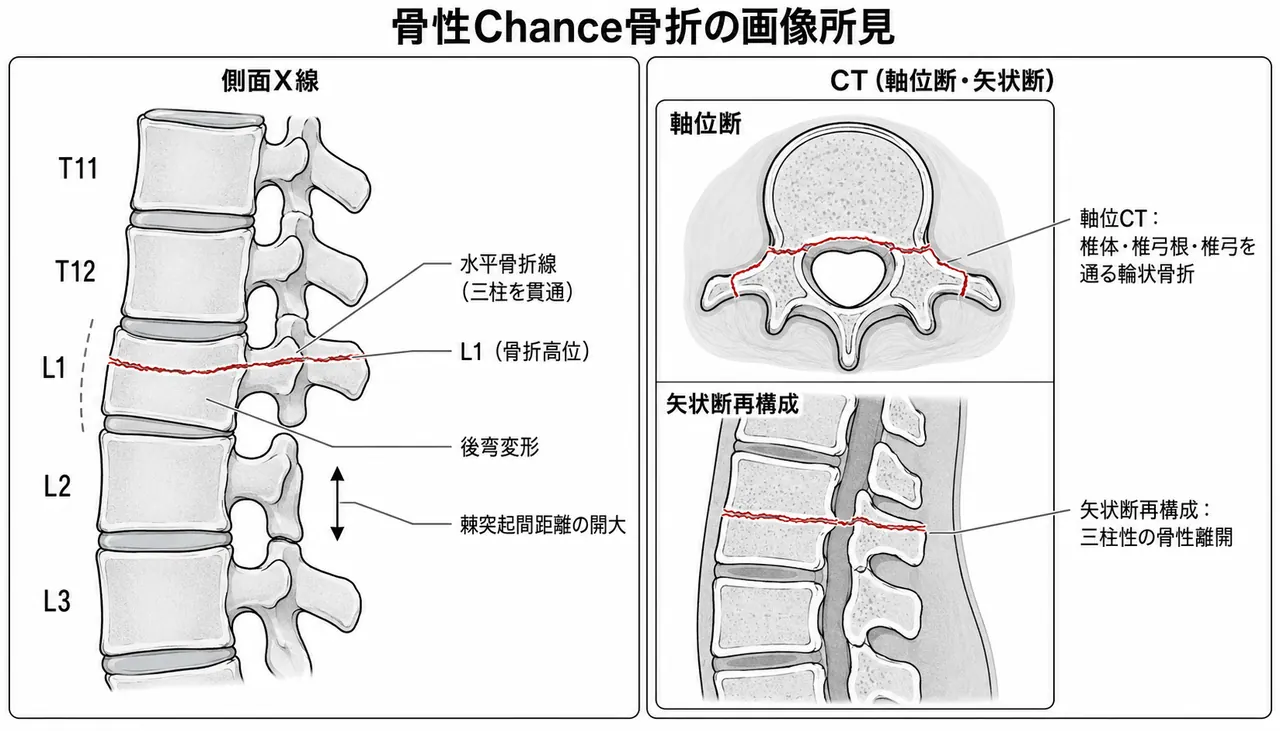 X線・CT所見 — Chance骨折の典型的骨折線（水平・三柱貫通）