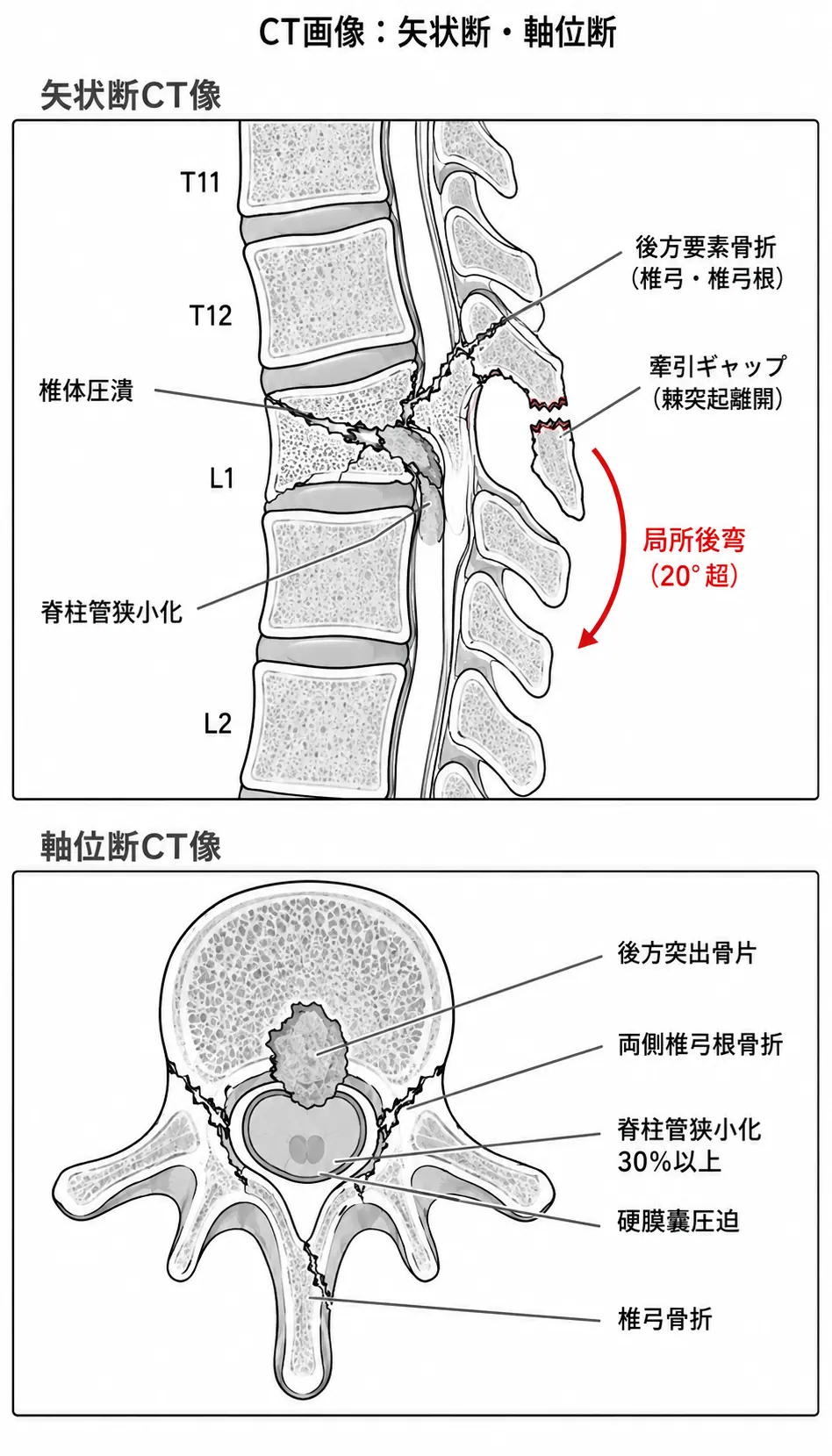 X線・CT像 — 後方要素骨折合併型（椎弓根骨折・後弯変形・脊柱管狭窄）