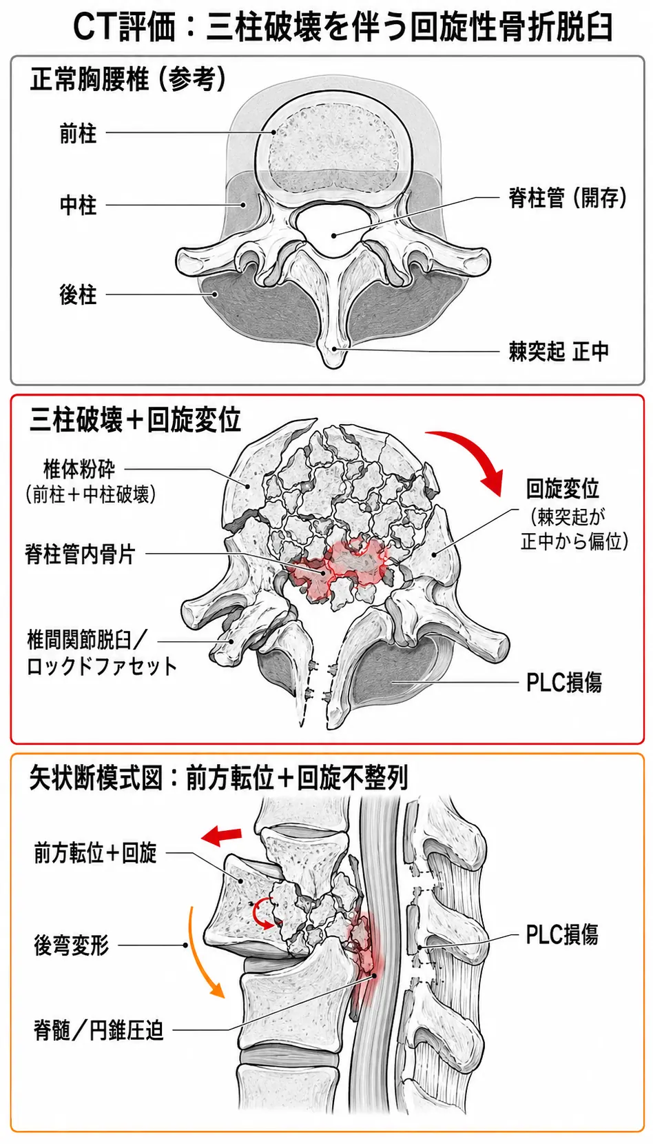 診断評価 — CT横断像で三柱破壊＋回旋変位を確認（後方靱帯複合体断裂・関節突起脱臼）