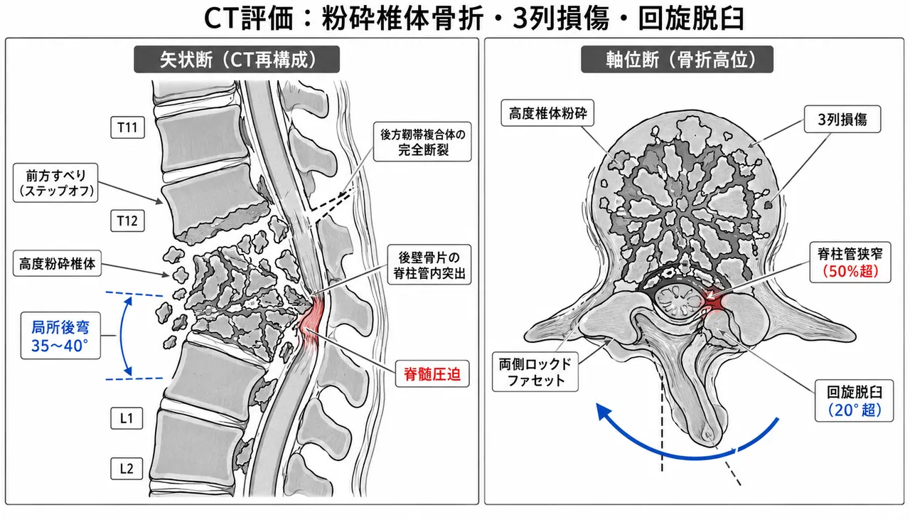 診断評価 — CT矢状断・軸位断像で椎体粉砕＋三柱全破壊＋高度回旋脱臼を確認（関節突起嵌頓・脊柱管高度狭窄）
